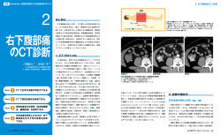 右下腹部痛 のCT診断