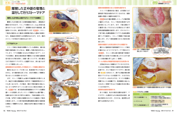 離開した正中創の管理と 並行して行うストーマケア